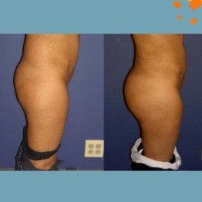 Before and after butt implants at ID Clinic Bangkok, enhanced gluteal contour result