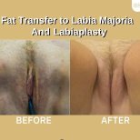 Before and after labia reduction and fat transfer results at ID Clinic Bangkok