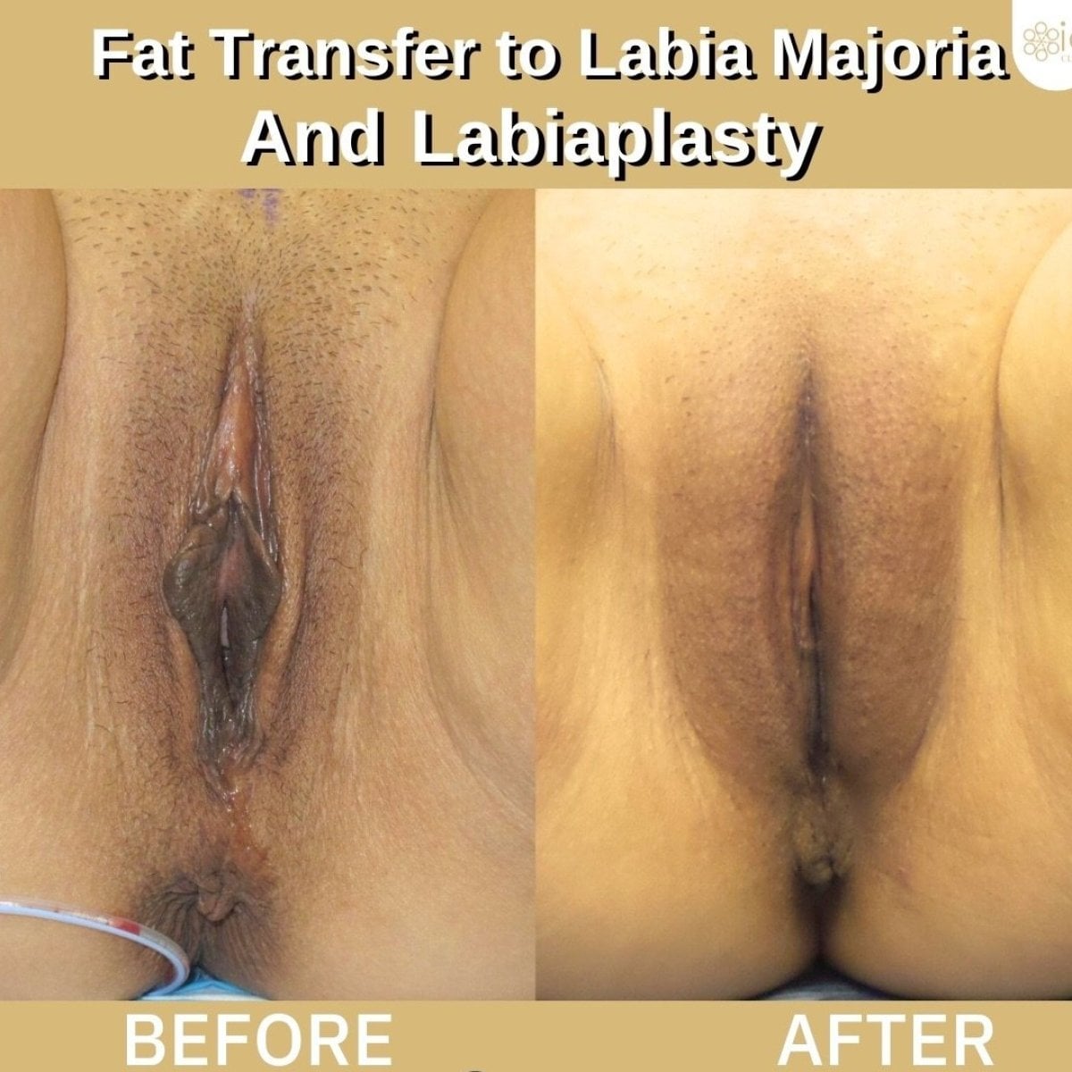Resultados antes y después de reducción de labios y lipofilling en ID Clinic Bangkok