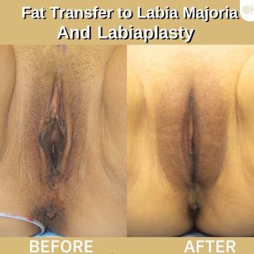 Before and after labia reduction and fat transfer results at ID Clinic Bangkok