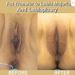 Before and after labia reduction and fat transfer results at ID Clinic Bangkok