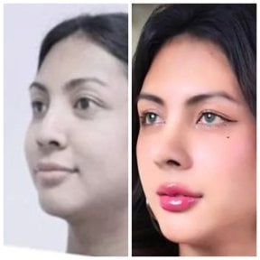 Vorher-nachher-Ergebnis der Nasenspitzenkorrektur in der Asia Cosmetic Hospital, verfeinerte Nase