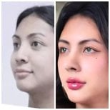 Vorher-nachher-Ergebnis der Nasenspitzenkorrektur in der Asia Cosmetic Hospital, verfeinerte Nase