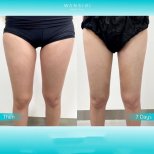 Before and after liposuction results at Wansiri Hospital, slimmer thighs after 7 days
