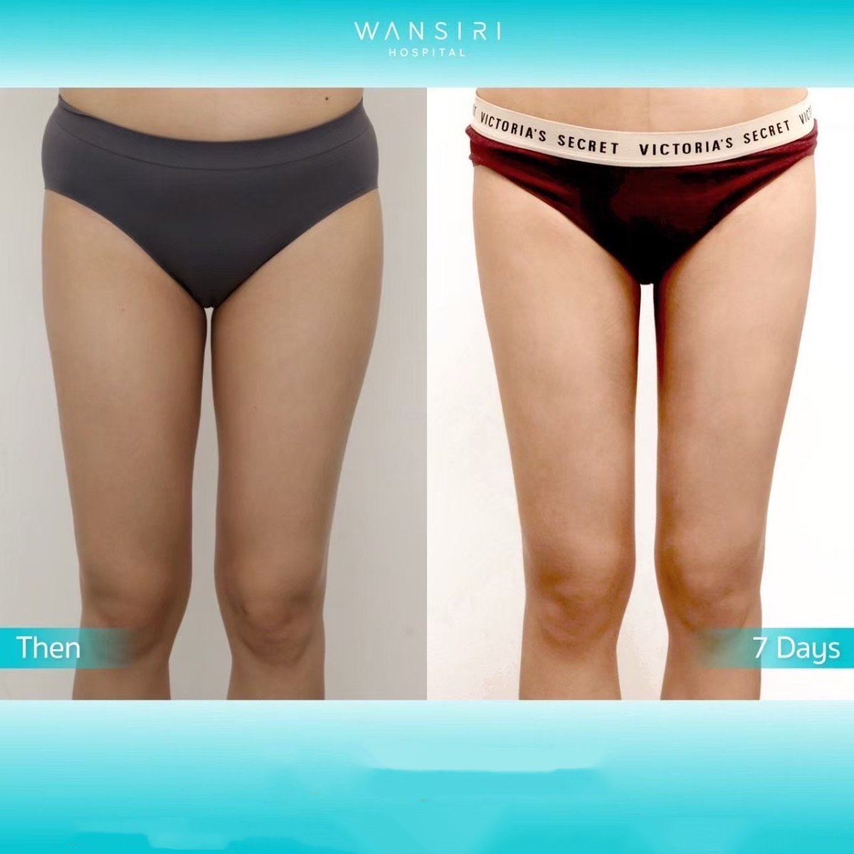Resultados de liposucción antes y después en Wansiri Hospital, muslos más delgados tras 7 días