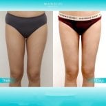 Before and after liposuction results at Wansiri Hospital, slimmer thighs after 7 days