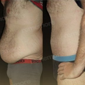 Before and after liposuction results at Memorial Bahçelievler Hospital, abdomen contouring