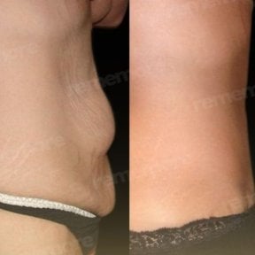 Before and after liposuction results at Memorial Bahçelievler Hospital, abdomen contouring