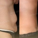 Before and after liposuction results at Memorial Bahçelievler Hospital, abdomen contouring