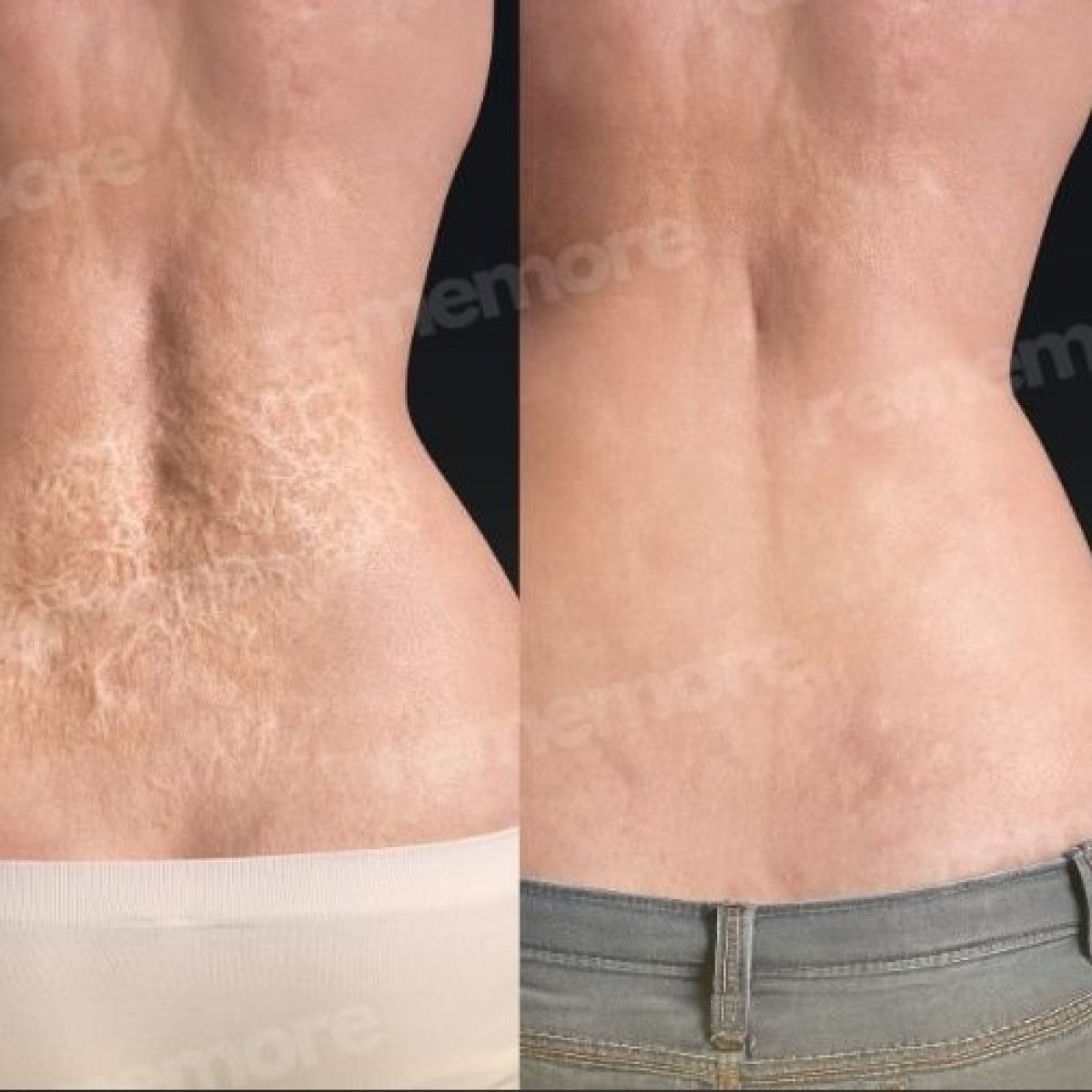 Resultados antes y después de la revisión de cicatrices en la zona lumbar en Memorial Bahçelievler