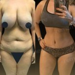 Before and after Vaser liposuction results at Memorial Antalya Hospital, improved body contour