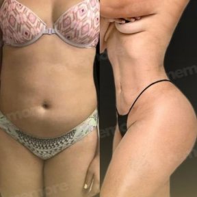 Before and after Vaser liposuction results at Memorial Antalya Hospital, body contour improvement