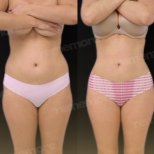 Before and after Vaser liposuction results at Memorial Antalya Hospital, improved body contour
