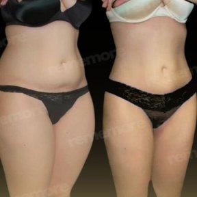 Before and after Vaser liposuction results at Memorial Antalya Hospital, slimmer waist contour