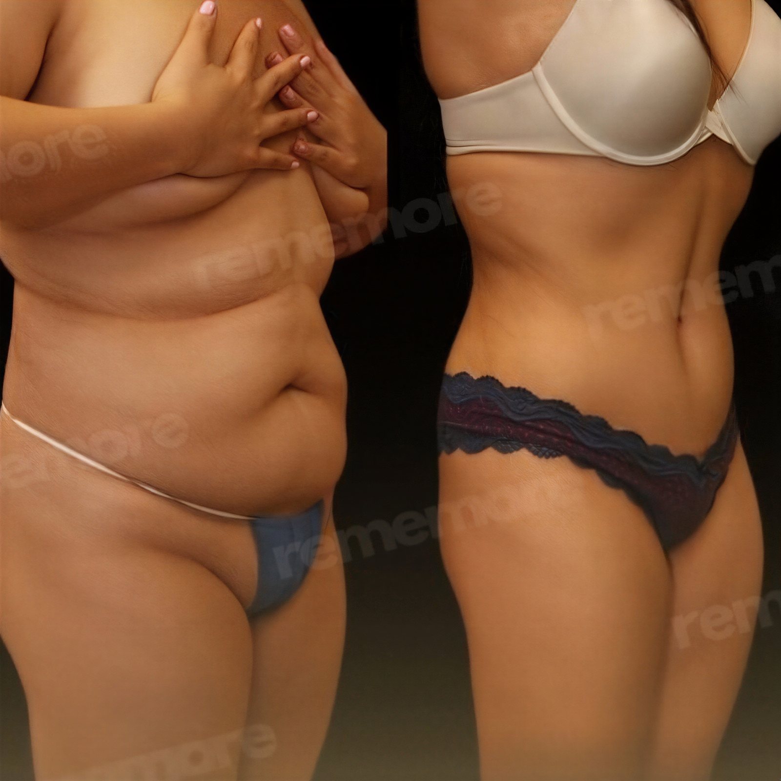 Resultados antes y después de liposucción Vaser en Memorial Antalya Hospital, mejora corporal