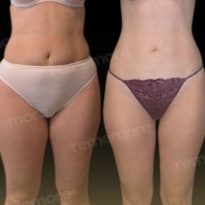 Before and after Vaser liposuction results at Memorial Antalya Hospital, body contour improvement
