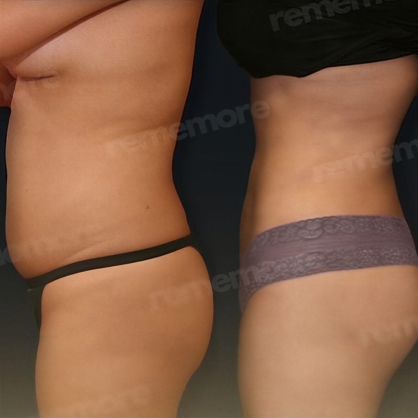 Resultados antes y después de liposucción Vaser en Memorial Antalya Hospital, mejor contorno corporal