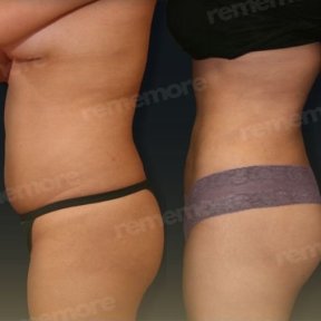 Before and after Vaser liposuction results at Memorial Antalya Hospital, improved body contour