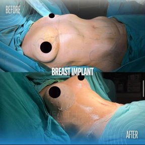 Before and after breast augmentation results at Memorial Şişli Hospital, enhanced breast shape