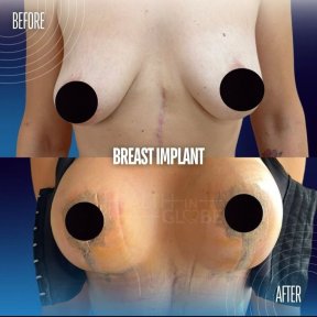 Before and after breast augmentation results at Memorial Şişli Hospital, fuller breast shape