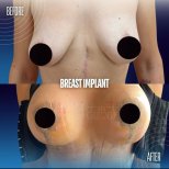 Before and after breast augmentation results at Memorial Şişli Hospital, fuller breast shape
