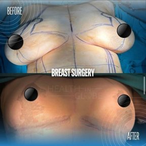 Результаты до и после увеличения груди в Memorial Şişli Hospital, улучшенная форма груди