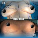 Результаты до и после увеличения груди в Memorial Şişli Hospital, улучшенная форма груди