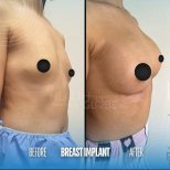 Результаты до и после увеличения груди в Memorial Şişli Hospital, увеличенный объем груди