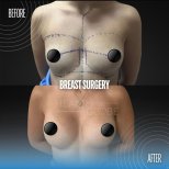 Результаты до и после увеличения груди в Memorial Şişli Hospital, улучшенная форма груди