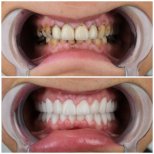 Vorher-nachher-Ergebnis Porzellanveneers bei YEG Clinic – weißeres Lächeln