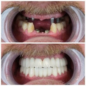 Vorher-nachher-Ergebnis von Porzellanveneers bei YEG Clinic, vollständige Zahnsanierung