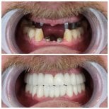Vorher-nachher-Ergebnis von Porzellanveneers bei YEG Clinic, vollständige Zahnsanierung