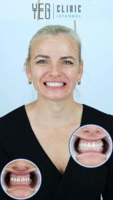Vorher-nachher-Ergebnis Porzellanveneers bei YEG Clinic – weißeres Lächeln