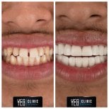 Vorher-nachher-Ergebnis Porzellanveneers bei YEG Clinic – verbesserte Ästhetik