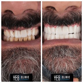 Vorher-nachher-Ergebnis Porzellanveneers bei YEG Clinic – weißeres, schöneres Lächeln