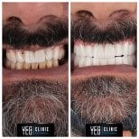 Vorher-nachher-Ergebnis Porzellanveneers bei YEG Clinic – weißeres, schöneres Lächeln