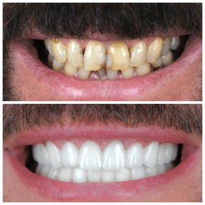Vorher-nachher-Ergebnis Porzellanveneers bei YEG Clinic – weißeres Lächeln