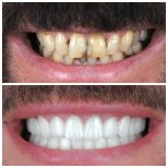 Vorher-nachher-Ergebnis Porzellanveneers bei YEG Clinic – weißeres Lächeln