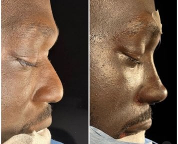 Vorher-nachher-Rhinoplastik-Ergebnisse bei Lokman Hekim Istanbul Hospital, verbesserte Nasenform