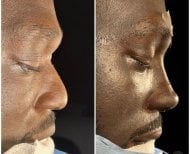 Vorher-nachher-Rhinoplastik-Ergebnisse bei Lokman Hekim Istanbul Hospital, verbesserte Nasenform