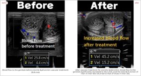 Before and after results of stem cell treatment for erectile dysfunction at RE:YOUTH clinic