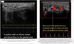 Before and after stem cell therapy for erectile dysfunction at RE:YOUTH, improved blood flow result