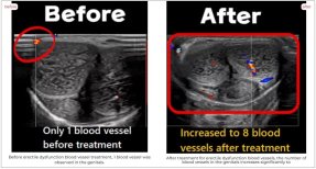 Before and after results of stem cell erectile dysfunction treatment at RE:YOUTH, improved blood flow