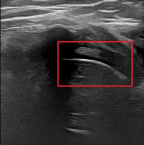 Ultrasound result after stem cell rejuvenation at RE:YOUTH (YONSEI BH Arterial Stemcell Clinic)