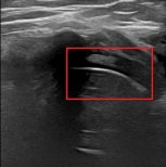 Ultrasound result after stem cell rejuvenation at RE:YOUTH (YONSEI BH Arterial Stemcell Clinic)