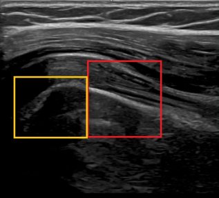 Ultrasound result after stem cell rejuvenation at RE:YOUTH (YONSEI BH Arterial Stemcell Clinic)
