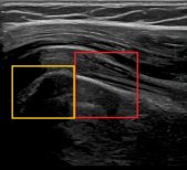 Ultrasound result after stem cell rejuvenation at RE:YOUTH (YONSEI BH Arterial Stemcell Clinic)