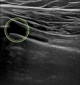 Ultrasound image showing stem cell injection site for rejuvenation at RE:YOUTH clinic