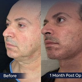 Before and after neck lift results at Dr. Safa Manav Clinic, visible jawline improvement