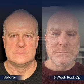 Before and after neck lift results at Dr. Safa Manav Clinic, visible jawline improvement